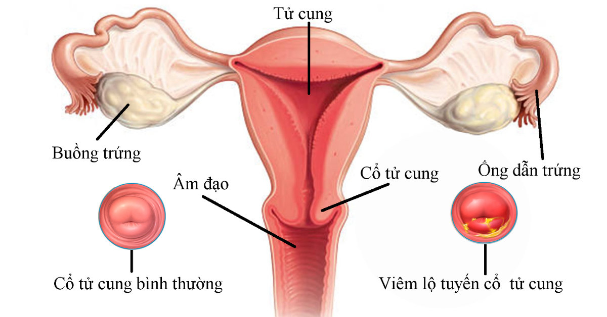 viem-lo-tuyen-co-tu-cung-la-gi