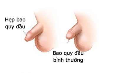 cau-nho-se-ra-sao-neu-bi-hep-bao-quy-dau