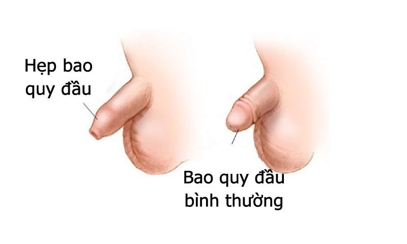 hep-bao-quy-dau-la-nhu-the-nao