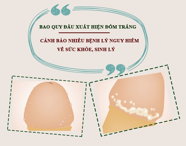 bao-quy-dau-xuat-hien-dom-trang-canh-bao-nhieu-benh-ly-nguy-hiem