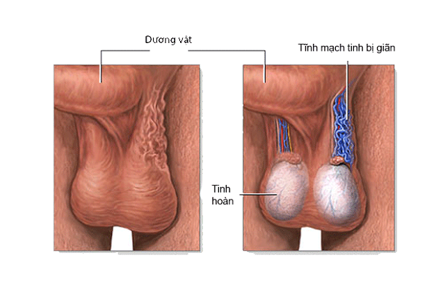 tinh-hoan-co-kich-thuoc-lon-la-nguyen-dan-dan-den-chay-xe