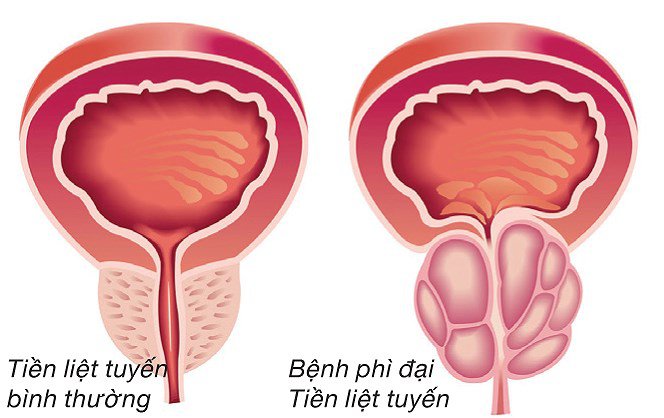 hinh-anh-ve-tuyen-tien-liet-binh-thuong-va-khi-bi-benh