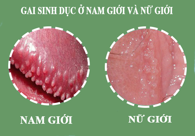 gai-sinh-duc-la-benh-gi