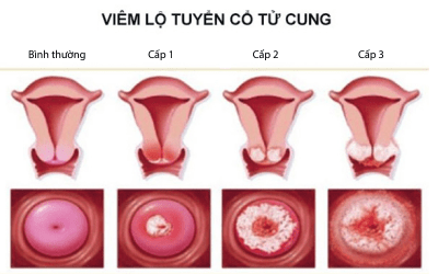 6-dau-hieu-cua-viem-lo-tuyen-co-tu-cung-ma-chi-em-can-biet-ngay